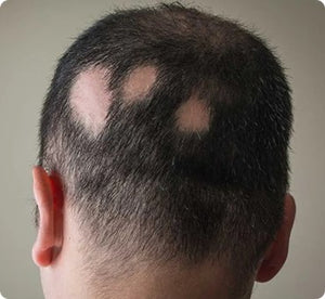 an example of Alopecia areata: blotches of hair loss.